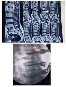 Complain of Sever Back Pain - dr adarsh patel