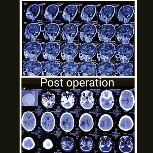 Treatment of Right Temporoparietal Brain Tumor - Dr Adarsh Patel Treatment of Right Temporoparietal Brain Tumor - Dr Adarsh Patel